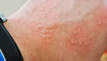 Diese Hautkrankheit betrifft 90% der Männer, aber sie schämen sich zu sehr, darüber zu sprechen Diese Hautkrankheit betrifft 90% der Männer, aber sie schämen sich zu sehr, darüber zu sprechen