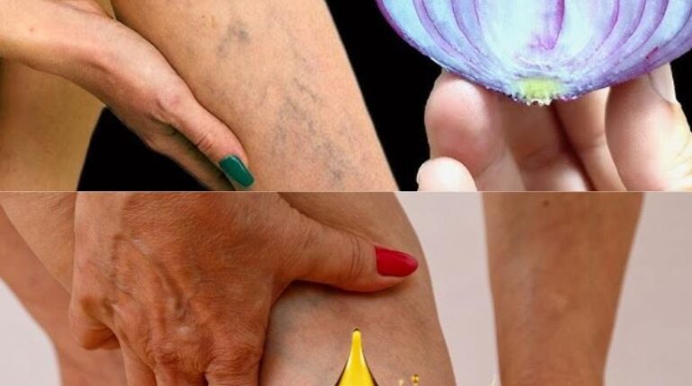 Circulation Health Tips Herbal Remedies Home Remedies Natural Treatments Varicose Veins 