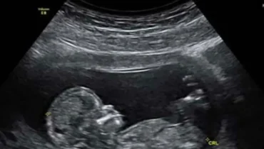 Mütterliches Mikrobiom und IL-17a-Molekül: Wie Wissenschaftler einen neuen biologischen Signalweg zum Autismus identifizierten Mütterliches Mikrobiom und IL-17a-Molekül: Wie Wissenschaftler einen neuen biologischen Signalweg zum Autismus identifizierten