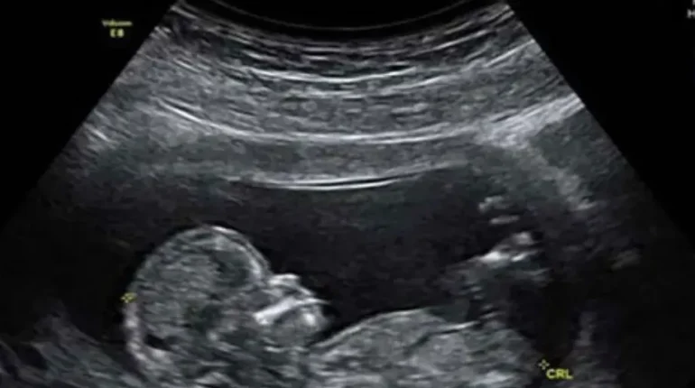 Autism Immune System Maternal Health Microbiome Neurodevelopment Research 