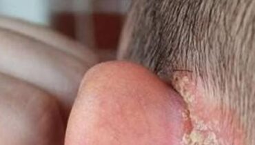 Diese Veränderungen an den Ohren Ihres Kindes könnten viel mehr als ein einfaches Hautproblem offenbaren Diese Veränderungen an den Ohren Ihres Kindes könnten viel mehr als ein einfaches Hautproblem offenbaren