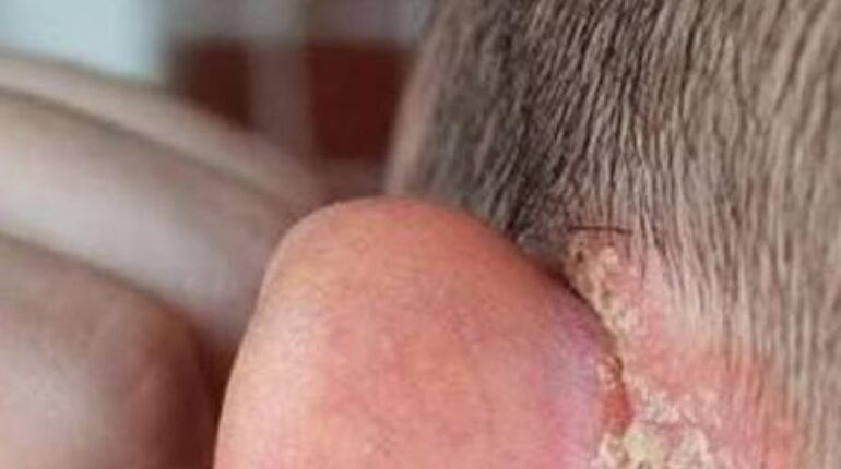 Baby Care Child Health Dermatology Eczema Medical Advice Parenting Tips Skin Conditions 