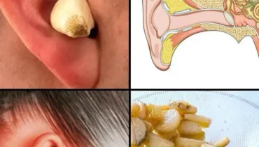 Knoblauchöl bei Ohrinfektionen: Wie dieses natürliche antibakterielle Mittel Schmerzen lindert und Ohrenschmalz entfernt Knoblauchöl bei Ohrinfektionen: Wie dieses natürliche antibakterielle Mittel Schmerzen lindert und Ohrenschmalz entfernt