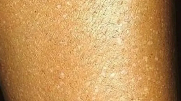 Aging Skin Dermatology Melanoma Skin Health Skin Spots Sun Exposure 