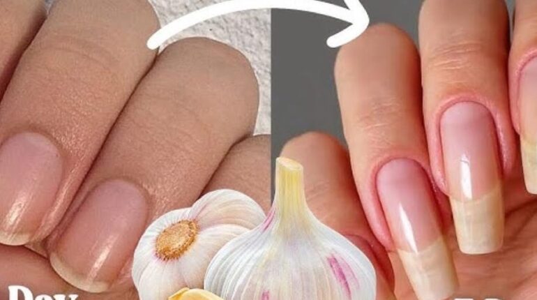 Beauty Tips Garlic Benefits Home Remedies Nail Care Natural Remedies Stronger Nails 