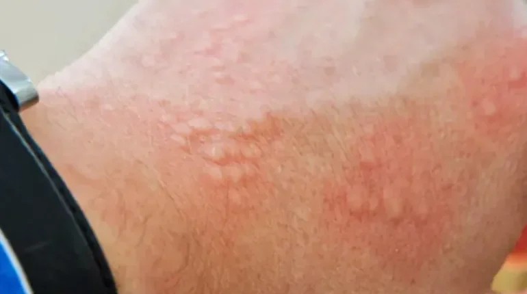 Chafing Contact dermatitis Folliculitis Fungal Infections Groin rash Skin irritation 