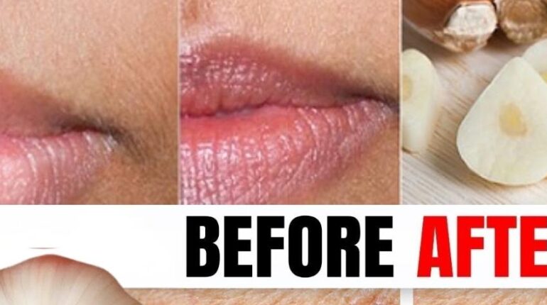 Dermatology Garlic Home Remedies Natural Treatments Skin Care Skin Tags 