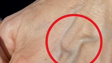 Sichtbare Venen: Wenn das plötzliche Auftreten auf Thrombose oder Lebererkrankung hinweist, jenseits kosmetischer Bedenken