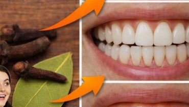 Zahnsteinentfernung und Zahnaufhellung: Wie tägliche Gewohnheiten und professionelle Pflege Zahnfleischerkrankungen natürlich verhindern Zahnsteinentfernung und Zahnaufhellung: Wie tägliche Gewohnheiten und professionelle Pflege Zahnfleischerkrankungen natürlich verhindern