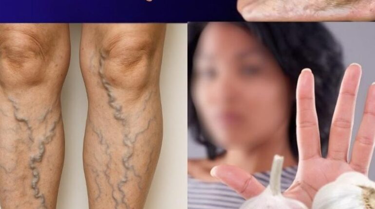 Circulation Cloves Daily Wellness Garlic Home Remedies Leg Care Natural Remedies 