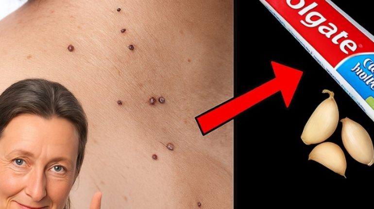 Apple Cider Vinegar Baking Soda Home Remedies Natural Remedies Skin Tags Tea Tree Oil Warts 