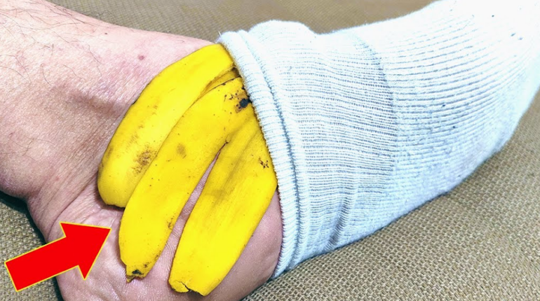 Banana Peels DIY Skincare Foot Care Home Remedies Natural Remedies 
