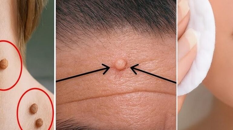 Beauty Hacks Dermatology DIY Skincare Home Remedies Natural Remedies Skin Tags Vaseline 