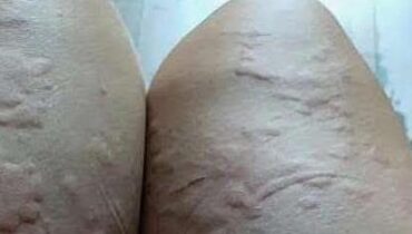 Genitalveränderungen der Haut: Was dieser erste Fleck wirklich bedeutet und wann man ärztliche Hilfe suchen sollte Genitalveränderungen der Haut: Was dieser erste Fleck wirklich bedeutet und wann man ärztliche Hilfe suchen sollte