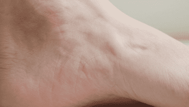 Trockene und schmerzhafte Fersen: 5 wirksame Naturheilmittel aus Alltagszutaten