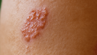 Gürtelrose: Das Varicella-Virus, das jahrzehntelang in Ihrer Wirbelsäule versteckt ist, kann sich reaktivieren und Ihre Nerven angreifen—Warum das 72-Stunden-Behandlungsfenster kritisch ist