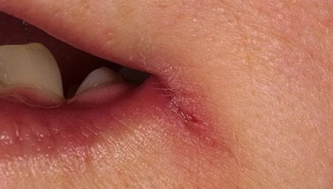 Nährstoffmängel: 5 Körpersymptome, die verraten, was Ihrer Ernährung fehlt