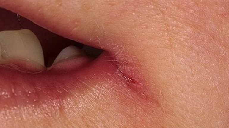 Bladder Health Body Symptoms Breuss Juice Diet Deficiencies Minerals Nutrition Vitamins 