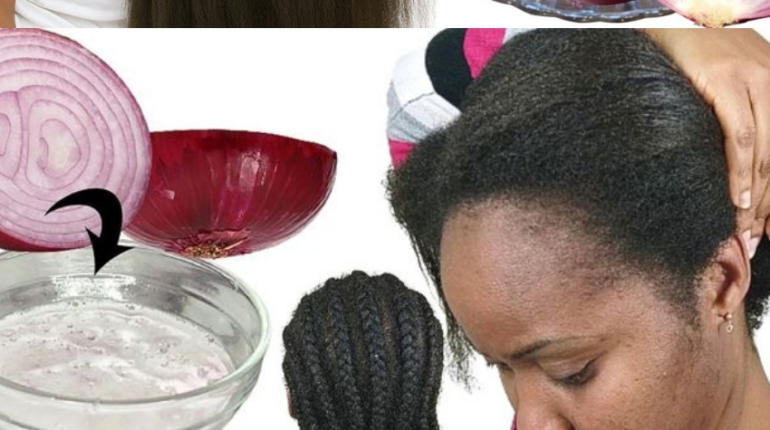 Hair Growth Natural Hair Care Natural Remedies Onion Juice Red Onion Scalp Health 