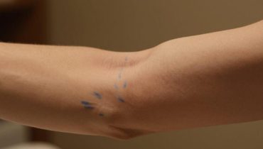 Sichtbare Venen am Abend: Thermische Vasodilatation und 6 weitere physiologische Ursachen erklärt Sichtbare Venen am Abend: Thermische Vasodilatation und 6 weitere physiologische Ursachen erklärt