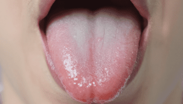 Weiße Zunge: 4 Gesundheitssignale, die Ihr Körper Ihnen sendet, und wie Sie sie natürlich beheben können Weiße Zunge: 4 Gesundheitssignale, die Ihr Körper Ihnen sendet, und wie Sie sie natürlich beheben können