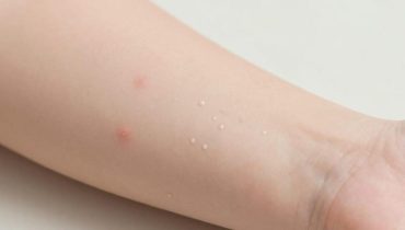 Molluscum contagiosum: Diese kleinen perlartigen Erhebungen auf der Haut von Kindern verschwinden nach 6 bis 12 Monaten von selbst Molluscum contagiosum: Diese kleinen perlartigen Erhebungen auf der Haut von Kindern verschwinden nach 6 bis 12 Monaten von selbst