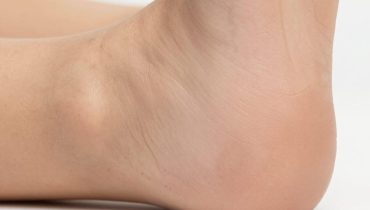 Rissige Fersen: 5 Alltagszutaten (Zwiebel, Banane, Aloe Vera), die die Geschmeidigkeit Ihrer Füße natürlich wiederherstellen