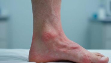 Geschwollene Füße: 8 schwere Krankheiten, die dieses Symptom offenbaren kann (Herz, Nieren, Leber)