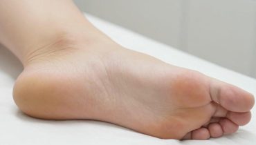 Dornwarzen: 5 validierte natürliche Heilmittel, um sie ohne Operation oder Chemikalien zu entfernen